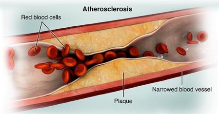 Image of blocked artery, Peace River Surgery Center