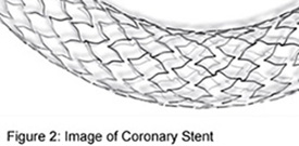 Image of Coronary Stint