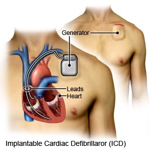 Implantable Cardiac Defibriilator (ICD)