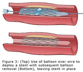 Coranary Angioplasty Diagram