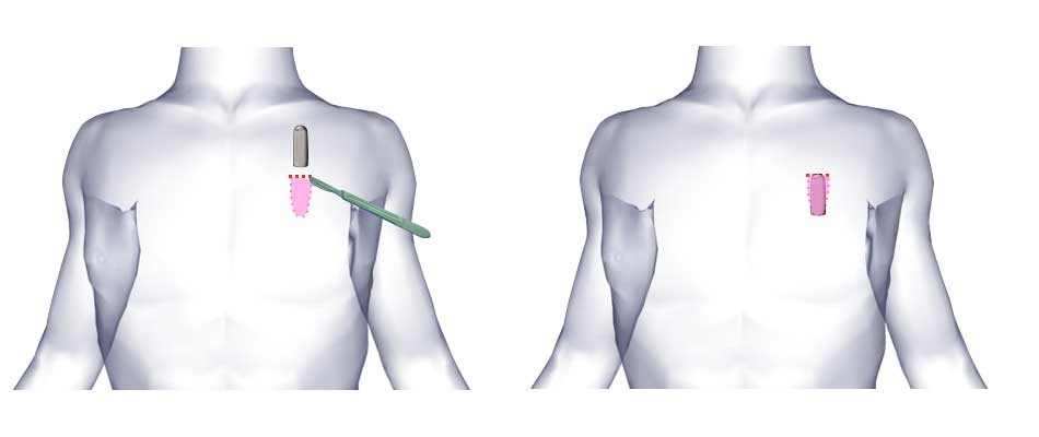 Loop Recorder Implant