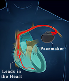 Coranary Angioplasty Diagram